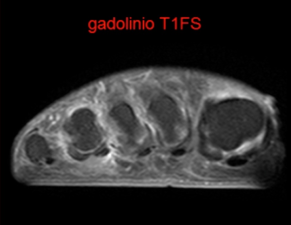 Figure 6 for case Advential bursitis